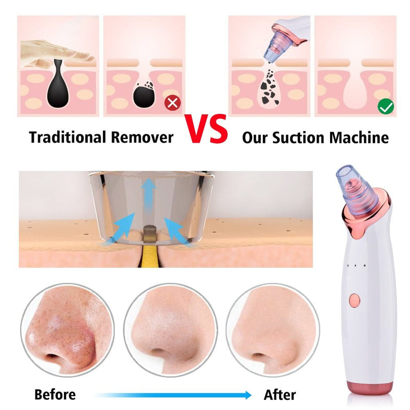 Blackhead Electric Suction